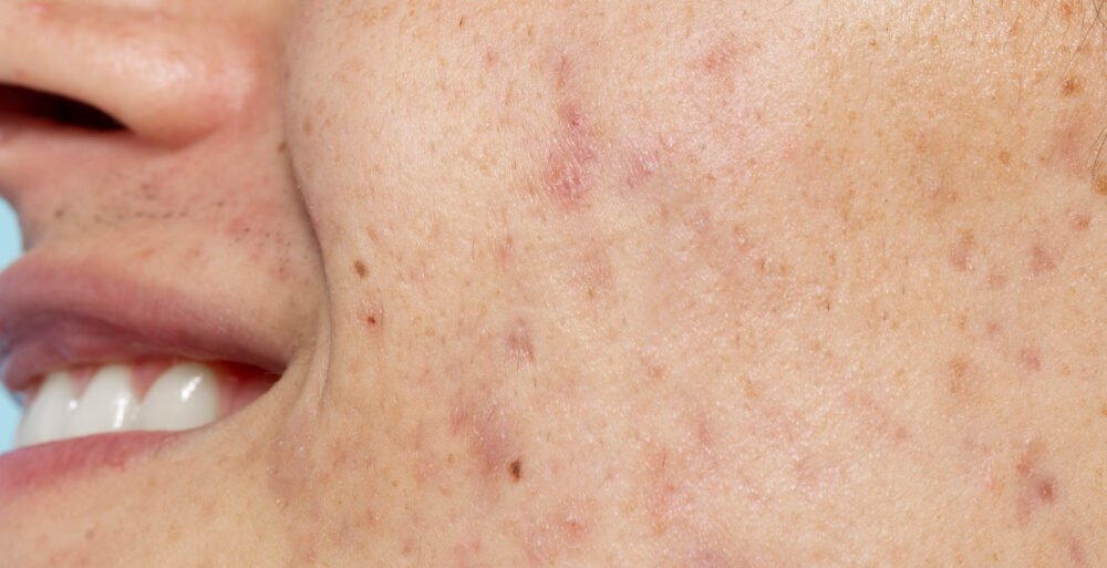 side-view-smiley-man-with-skin-problems