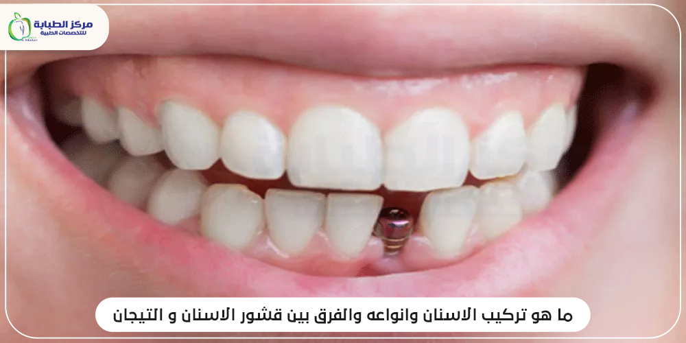 تركيب الاسنان