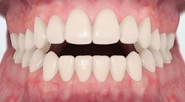 العضة المفتوحة